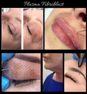 Wrinkles and fine lines are lifted and skin tightened with Plasma fibroblast